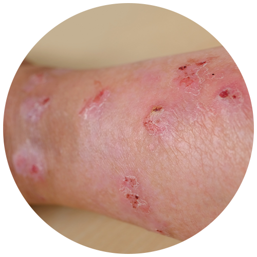 Stasis Dermatitis
