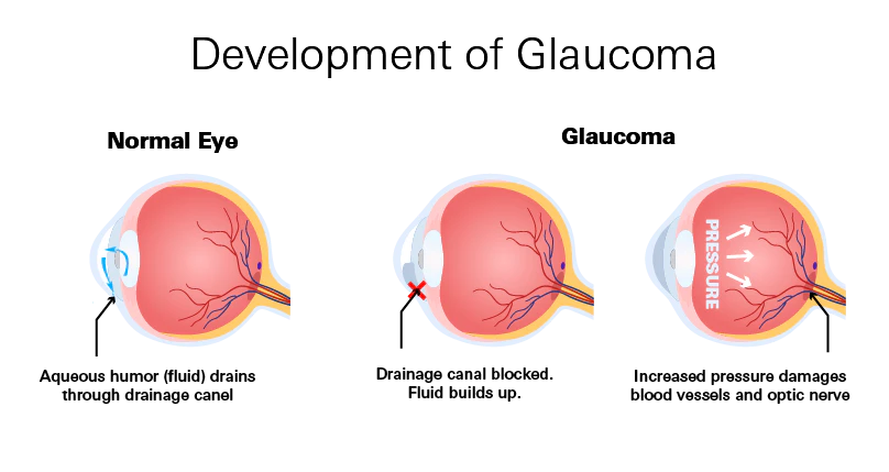 Glaucoma Development