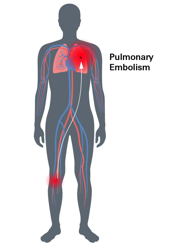 Pulmonary Embolism