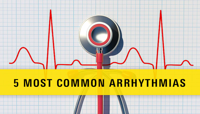 Arrhythmias