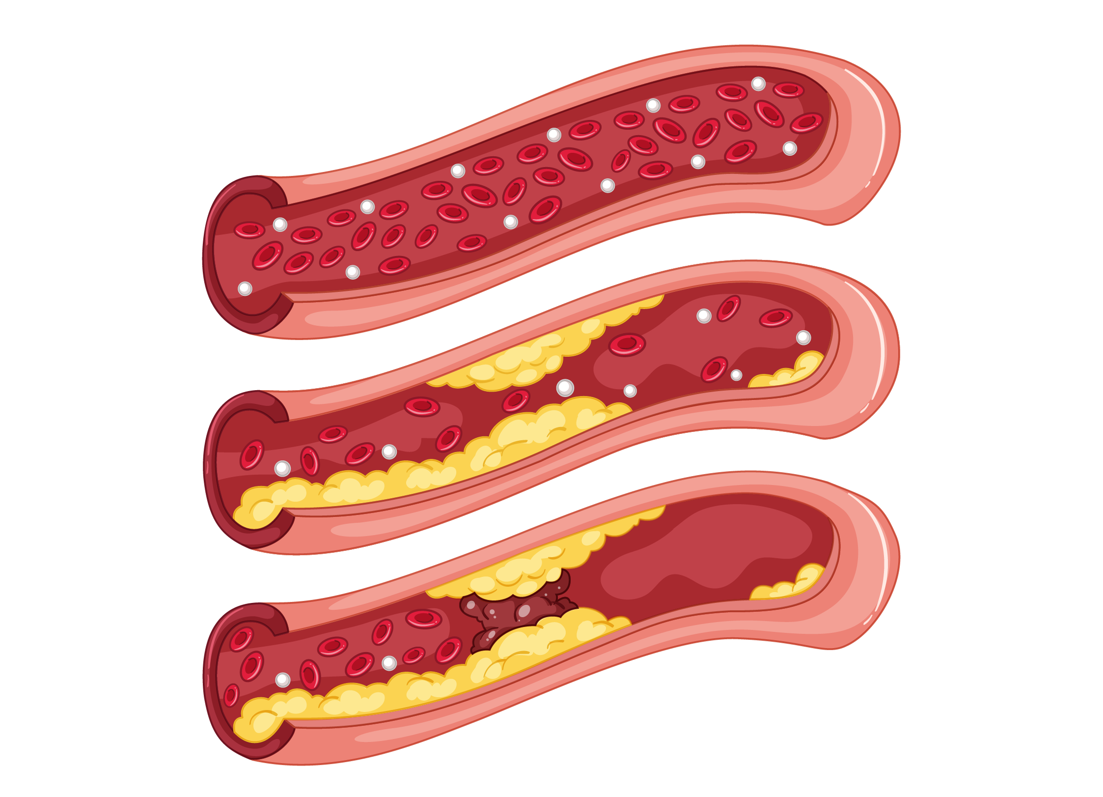 Blood clot from ruptured plaque