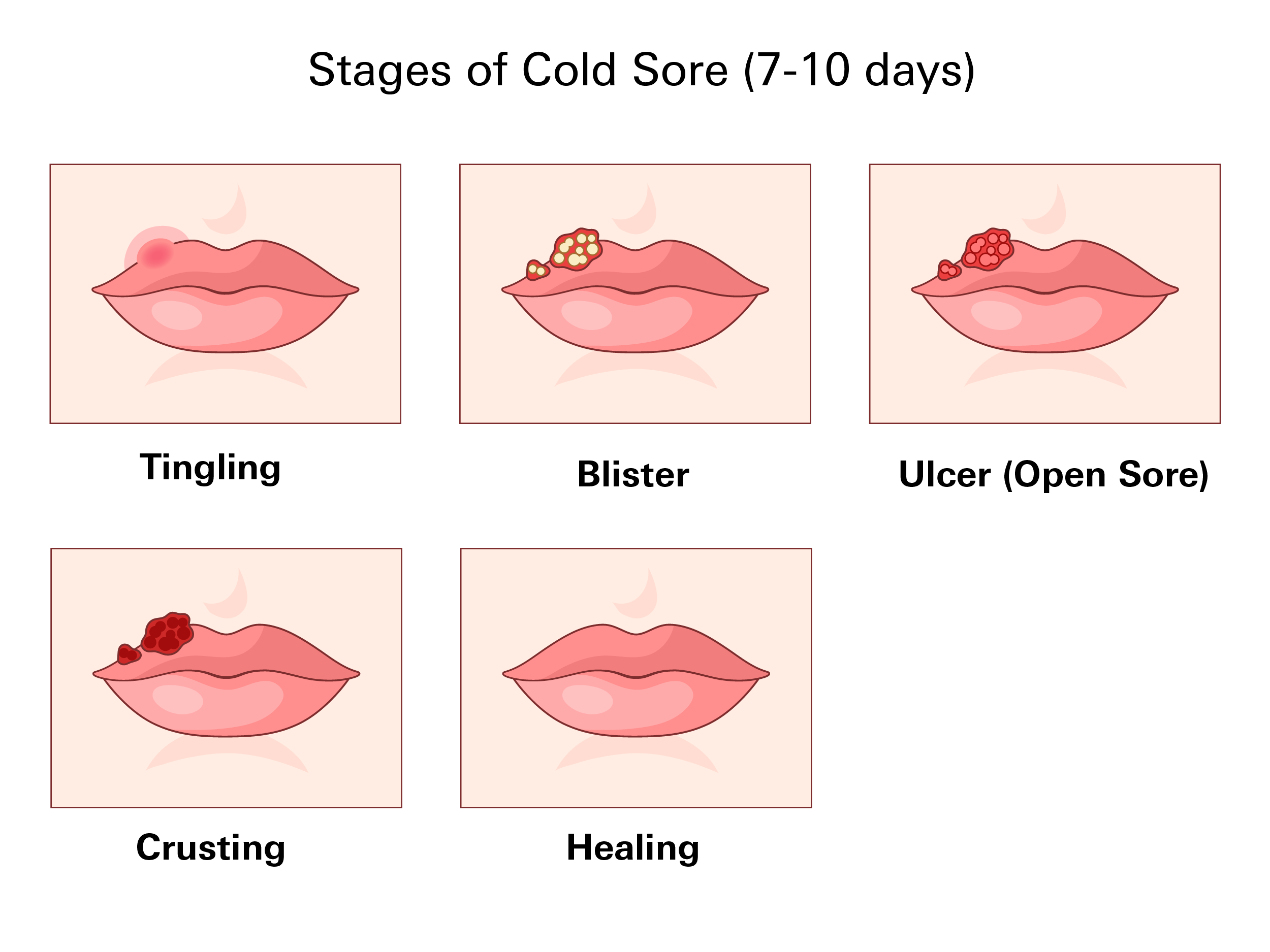 Cold sore stages