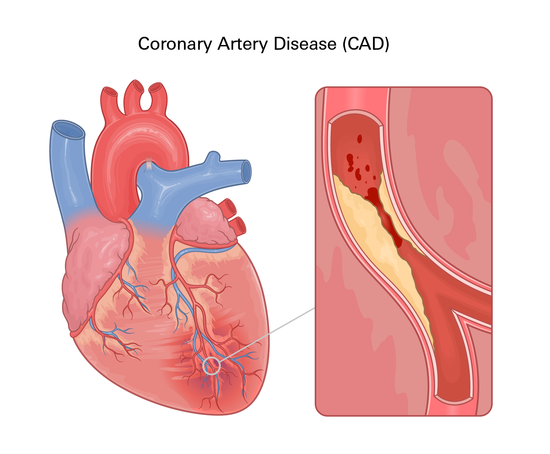 Coronary Artery Disease