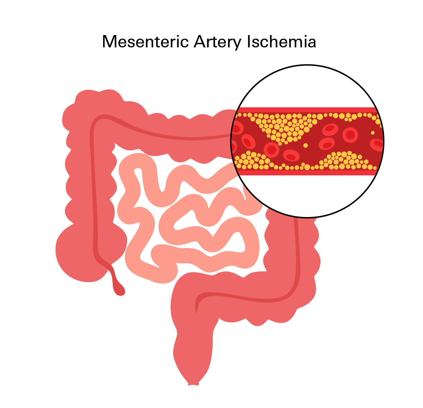 Mesenteric Artery Ischemia
