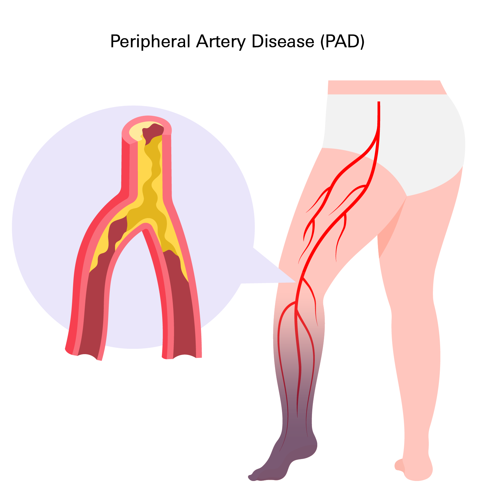 Peripheral Artery Disease