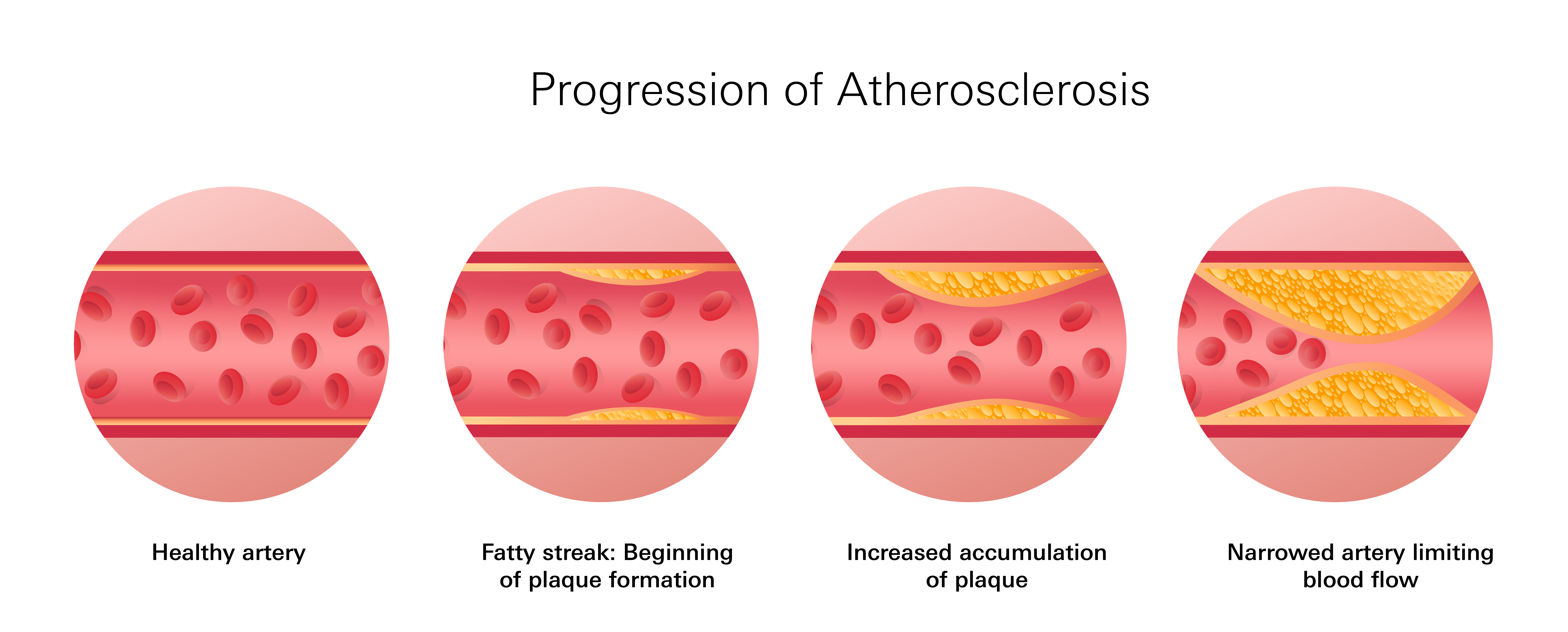 Progression of Atherosclerosis