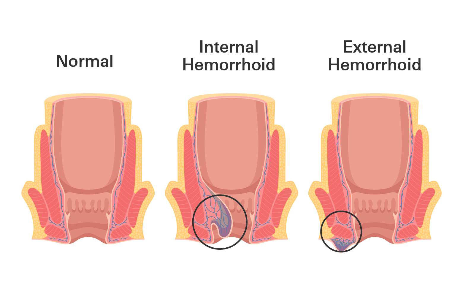 Hemorrhoids Types