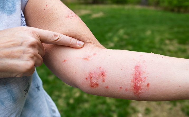 Poison Ivy Rash