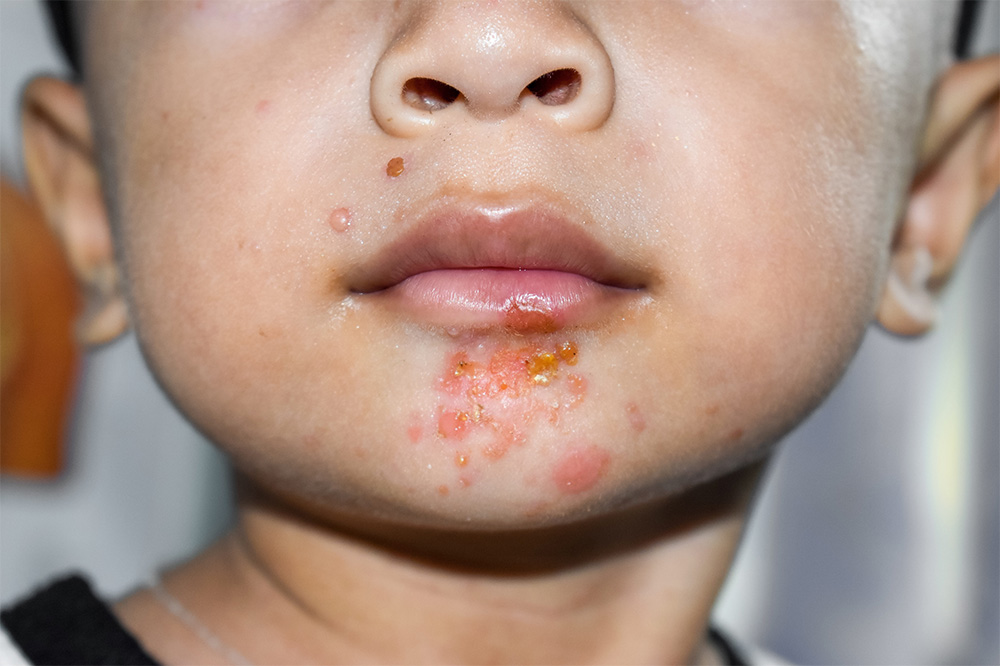 Impetigo