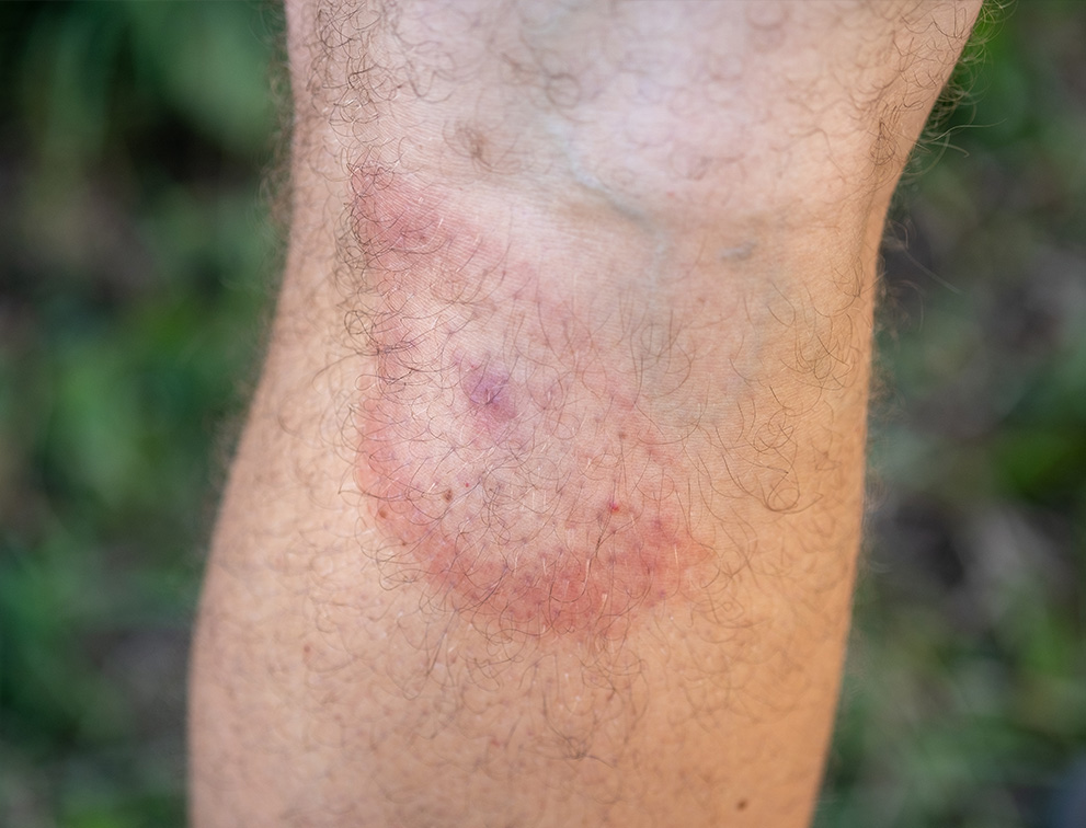 Bull's Eye Pattern from Tick Bite