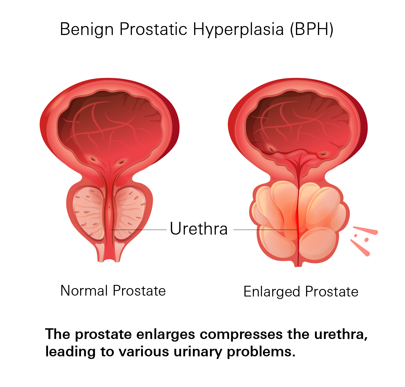 Benign Prostatic Hyperplasia