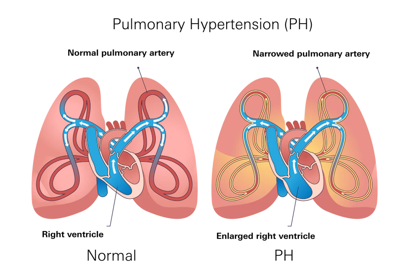 Pulmonary Hypertension