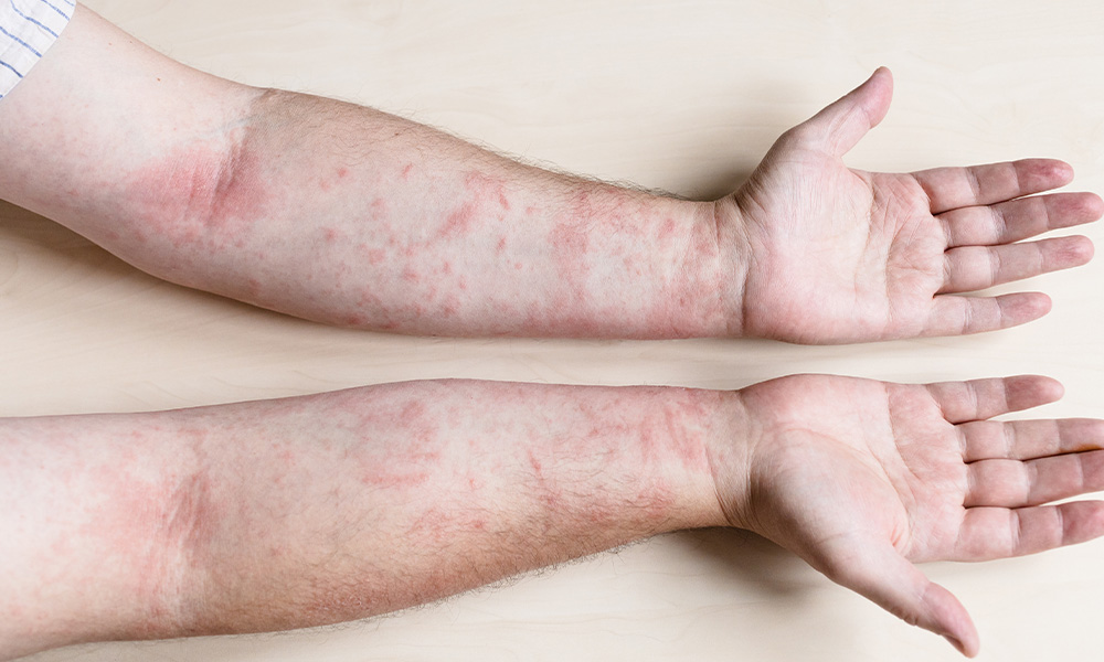 Allergic Contact Dermatitis