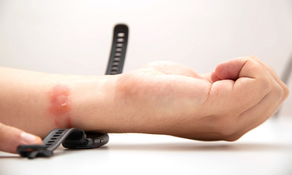 Irritant Contact Dermatitis