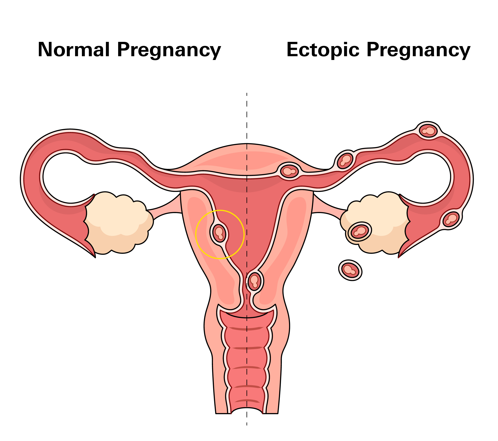 Ectopic Pregnancy
