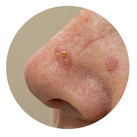 Actinic Keratoses