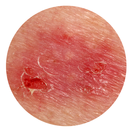 Superficial Basal Cell Carcinoma