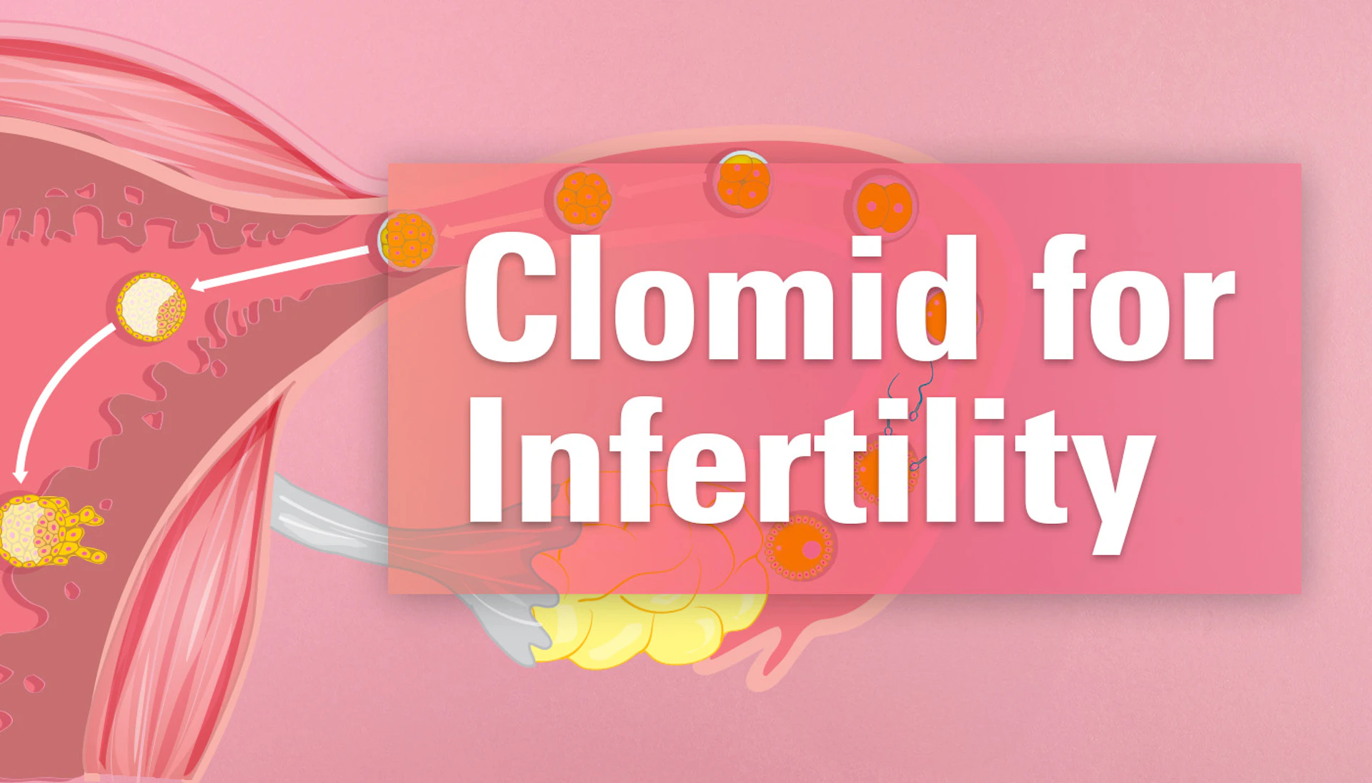 Clomid for infertility