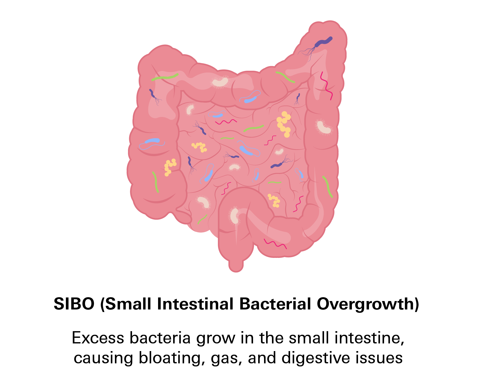 SIBO