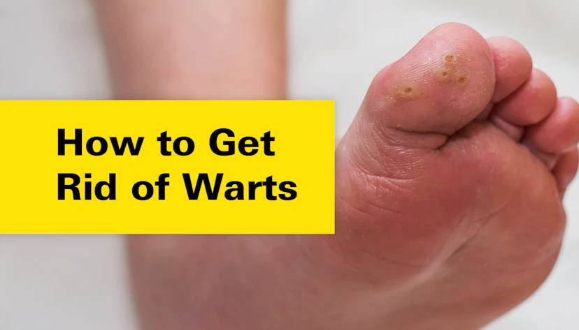 Warts
