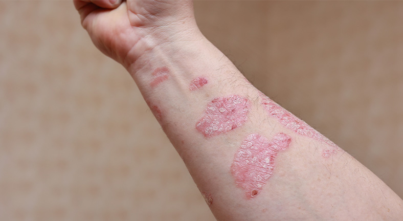 Psoriasis