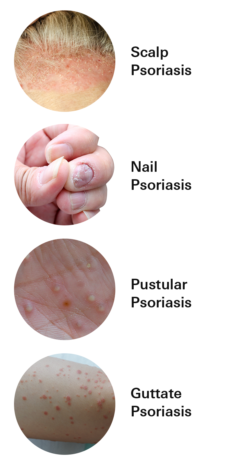 Types of Psoriasis