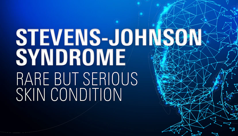 Stevens Johnson Syndrome