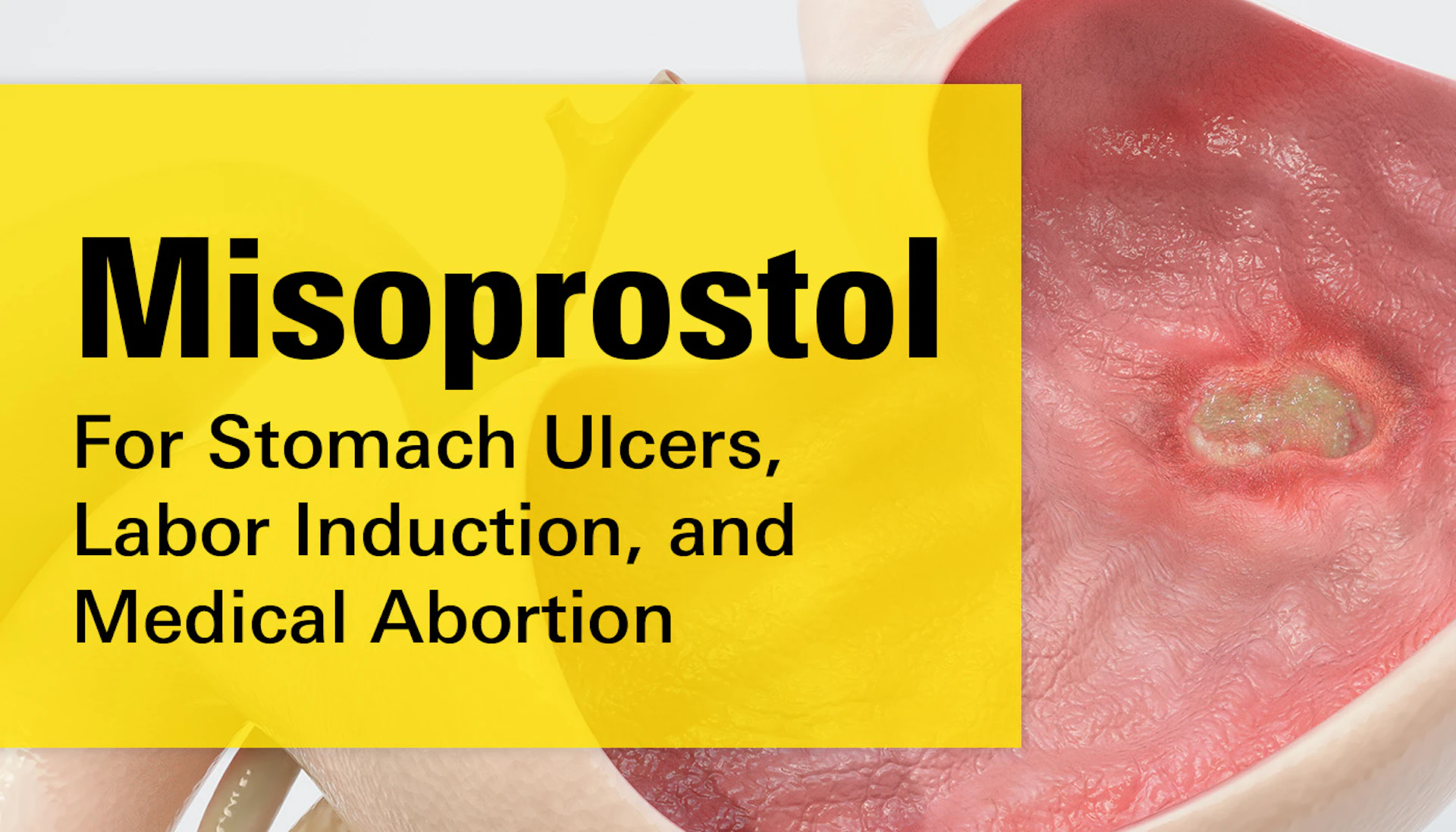 Misoprostol