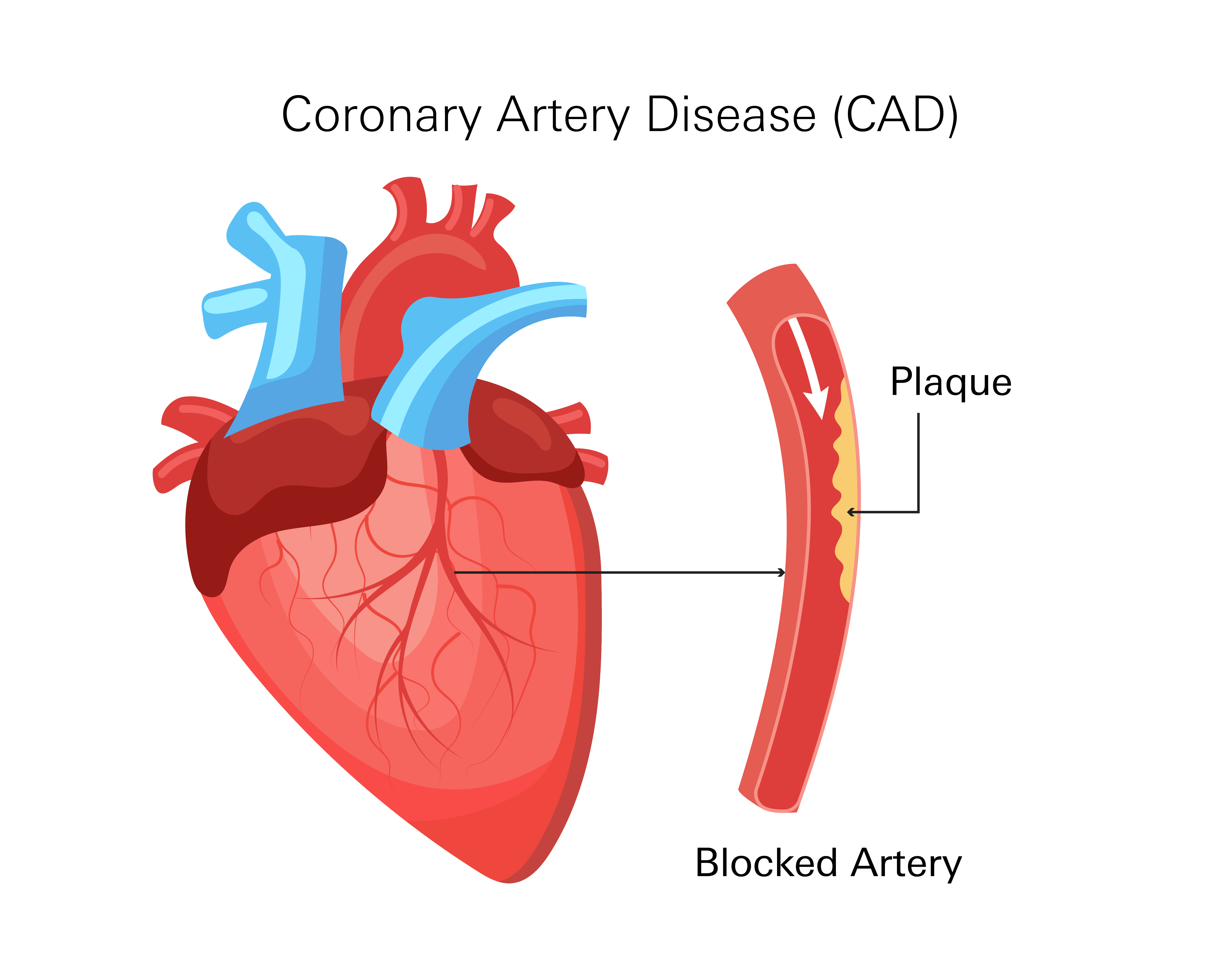 Coronary Artery Disease