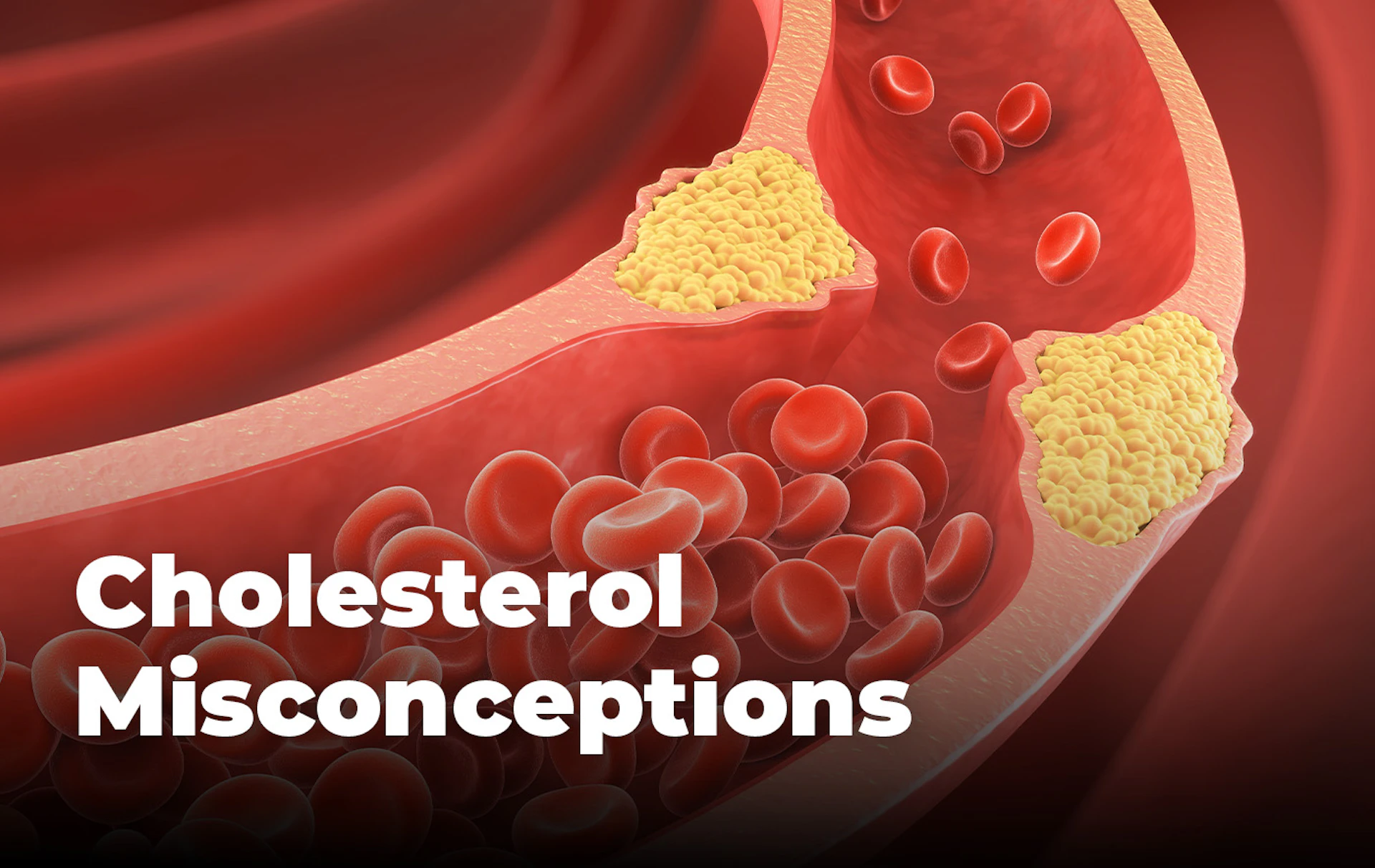 Cholesterol Misconceptions