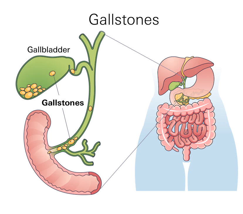 Gallstones0 5x