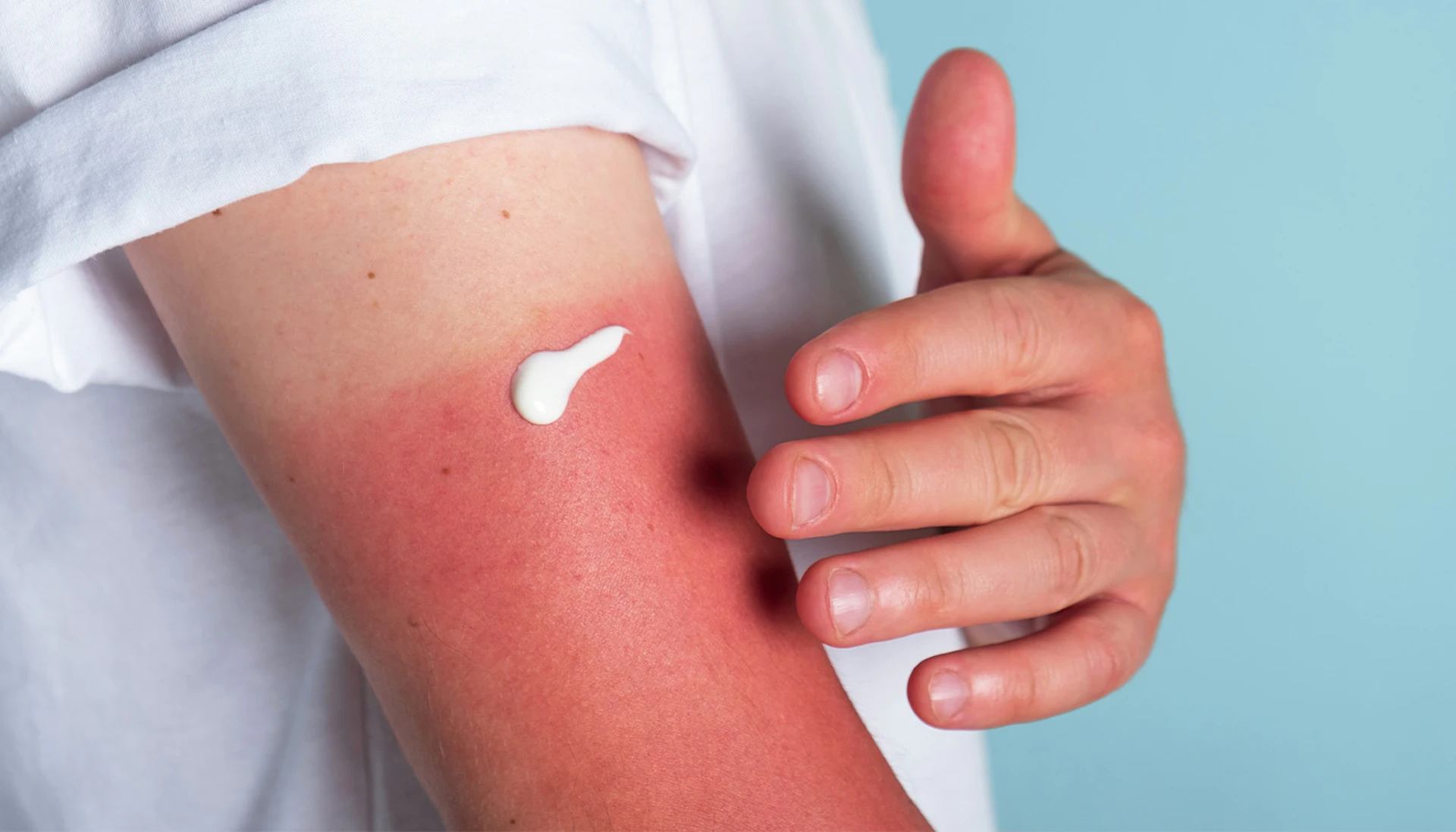 Sun Protection