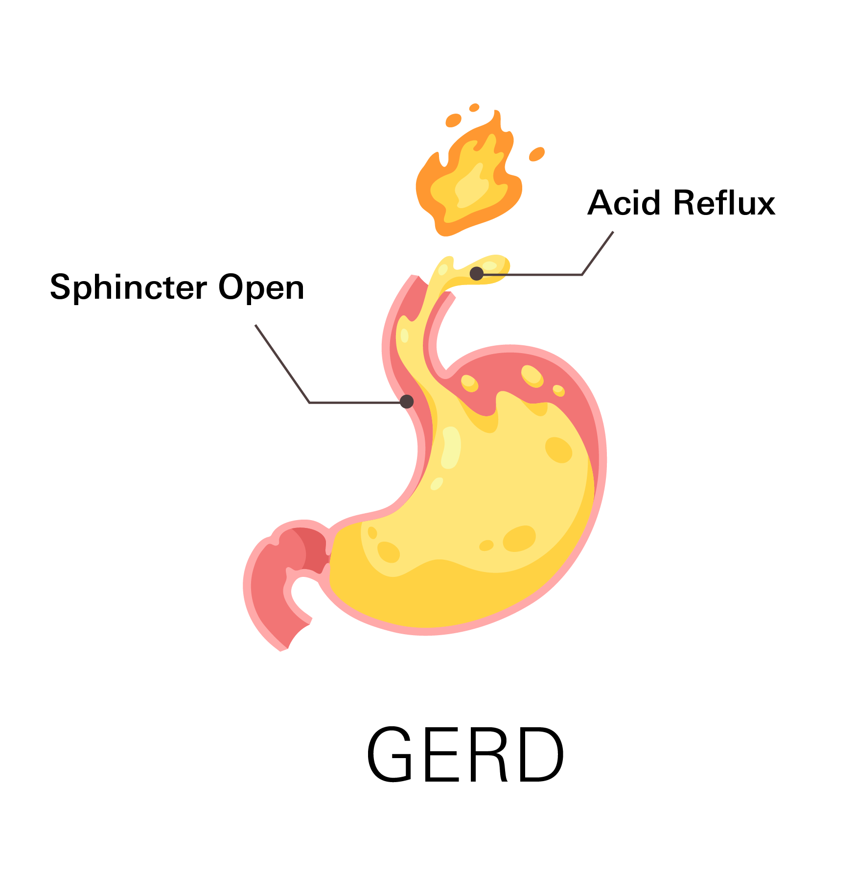 GERD stomach