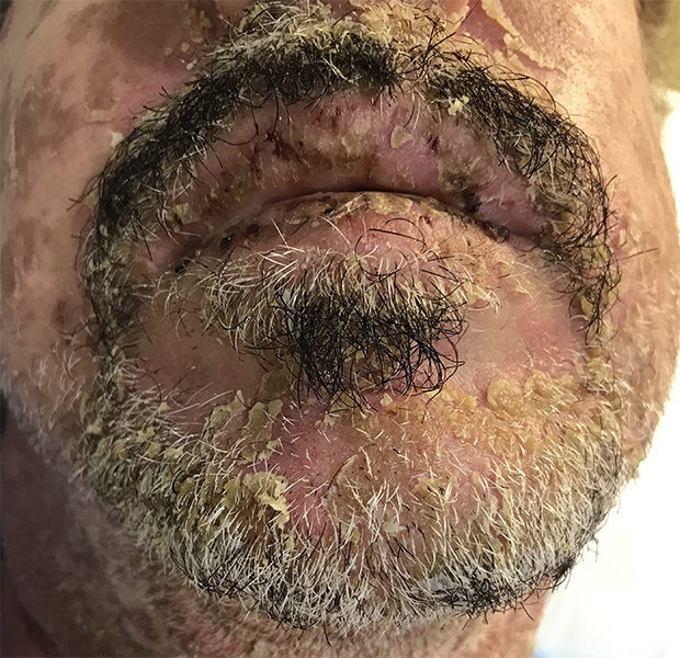 Stevens-Johnson Syndrome